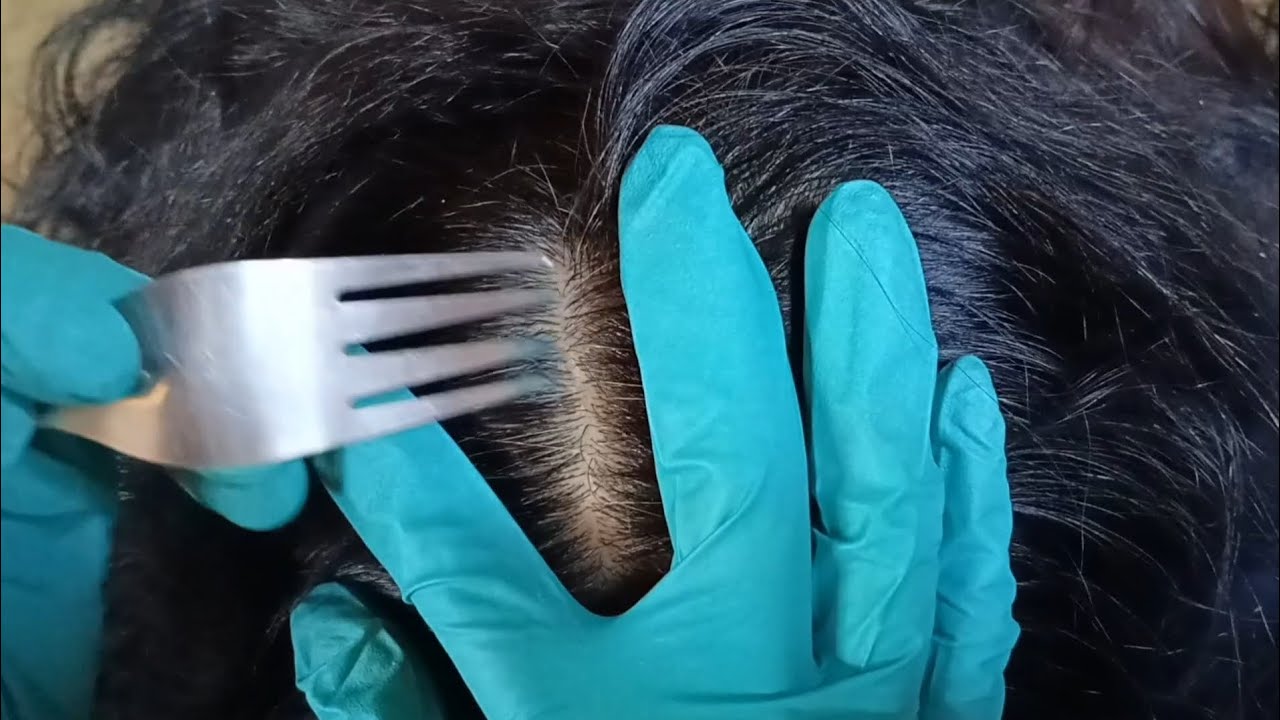 ASMR: Removing Dry Dandruff From Hair