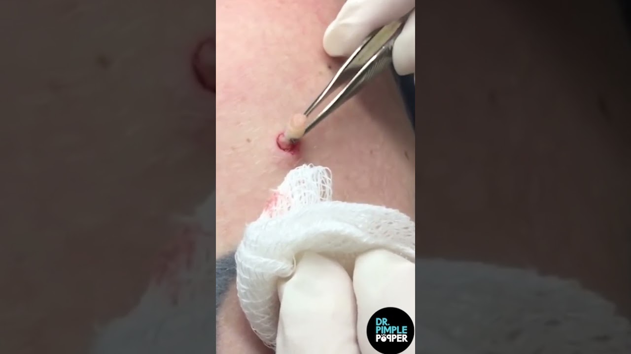 A Hard Pops Medley by Dr. Pimple Popper
