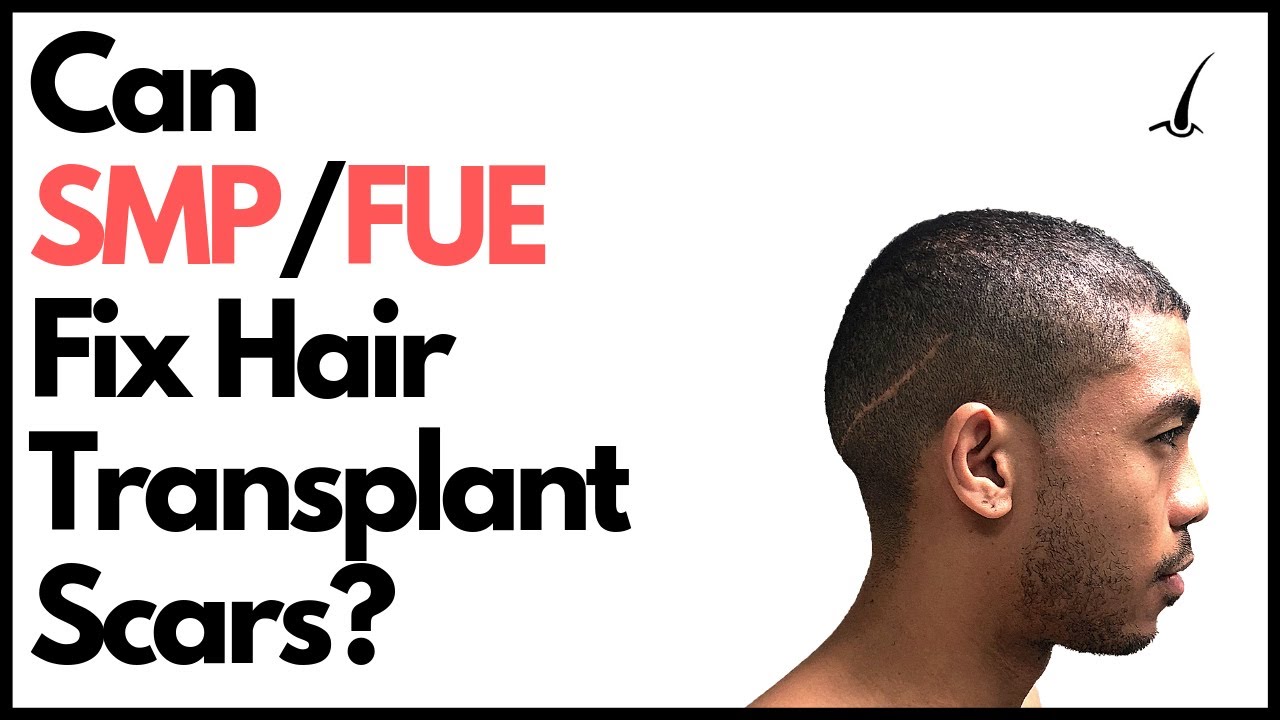 The TRUTH about FUE Scar Repair and Scalp Micropigmentation