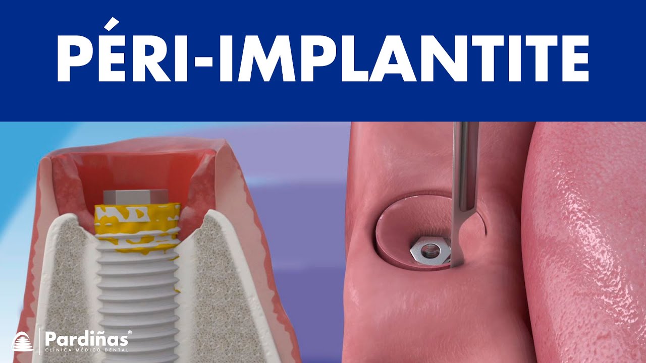 La péri-implantite ©
