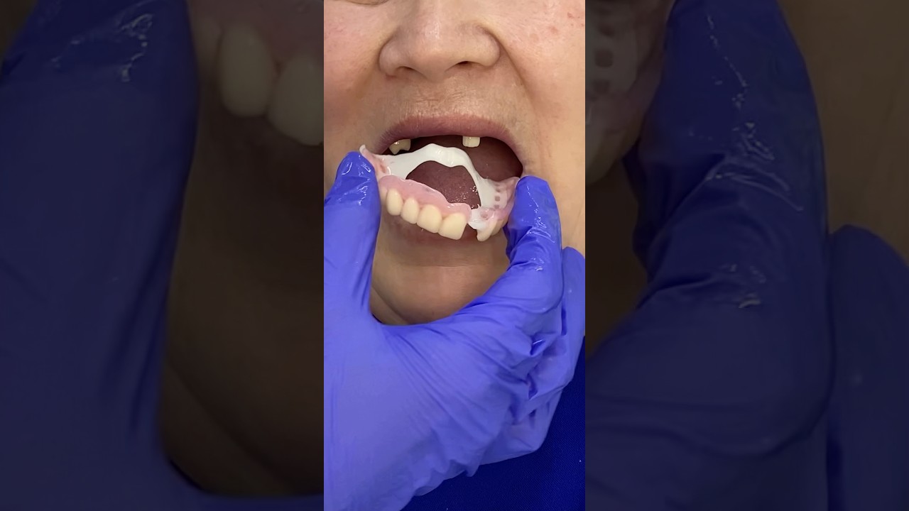 Flexible dentures. How to fix a dentures? #dentures