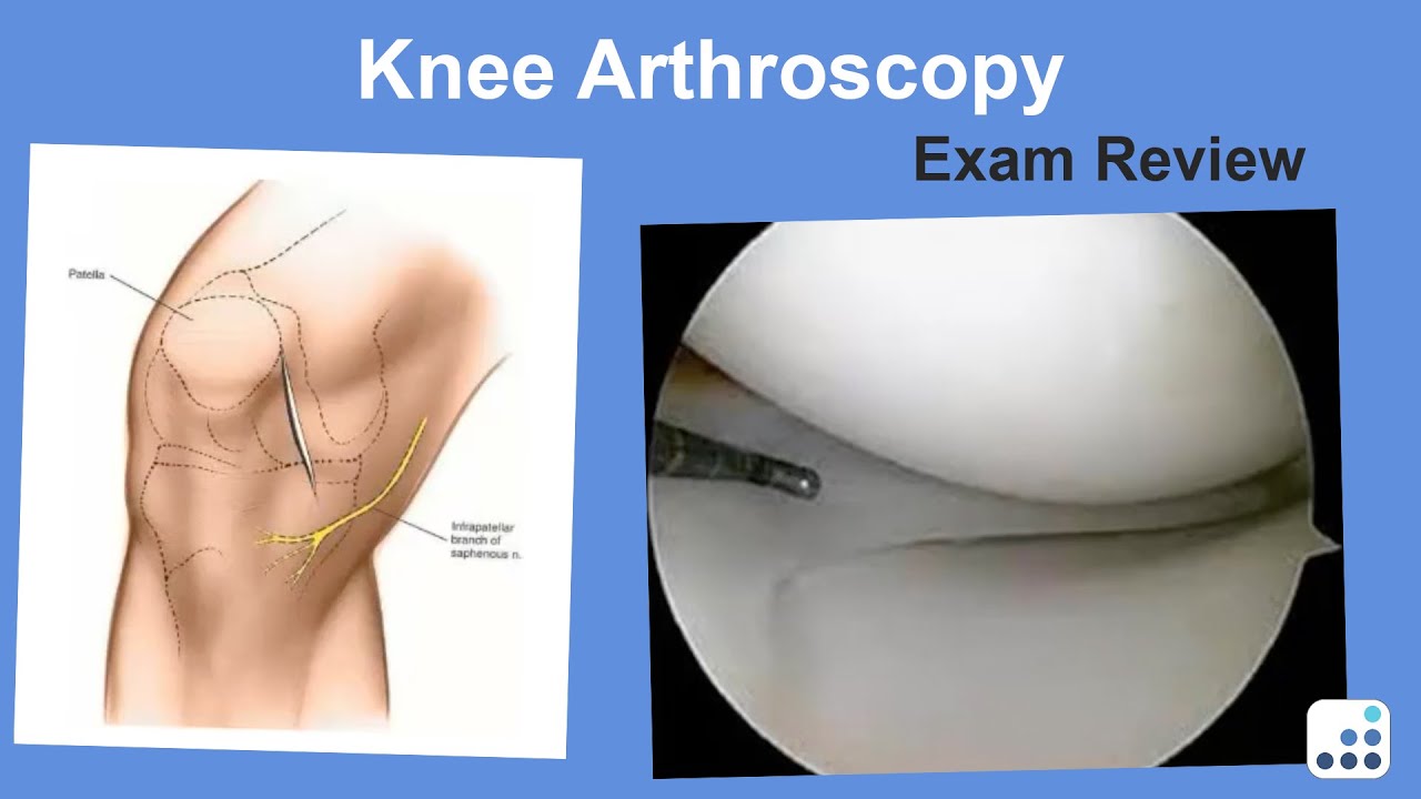 Knee Arthroscopy Exam Review - Ron Delanois, MD