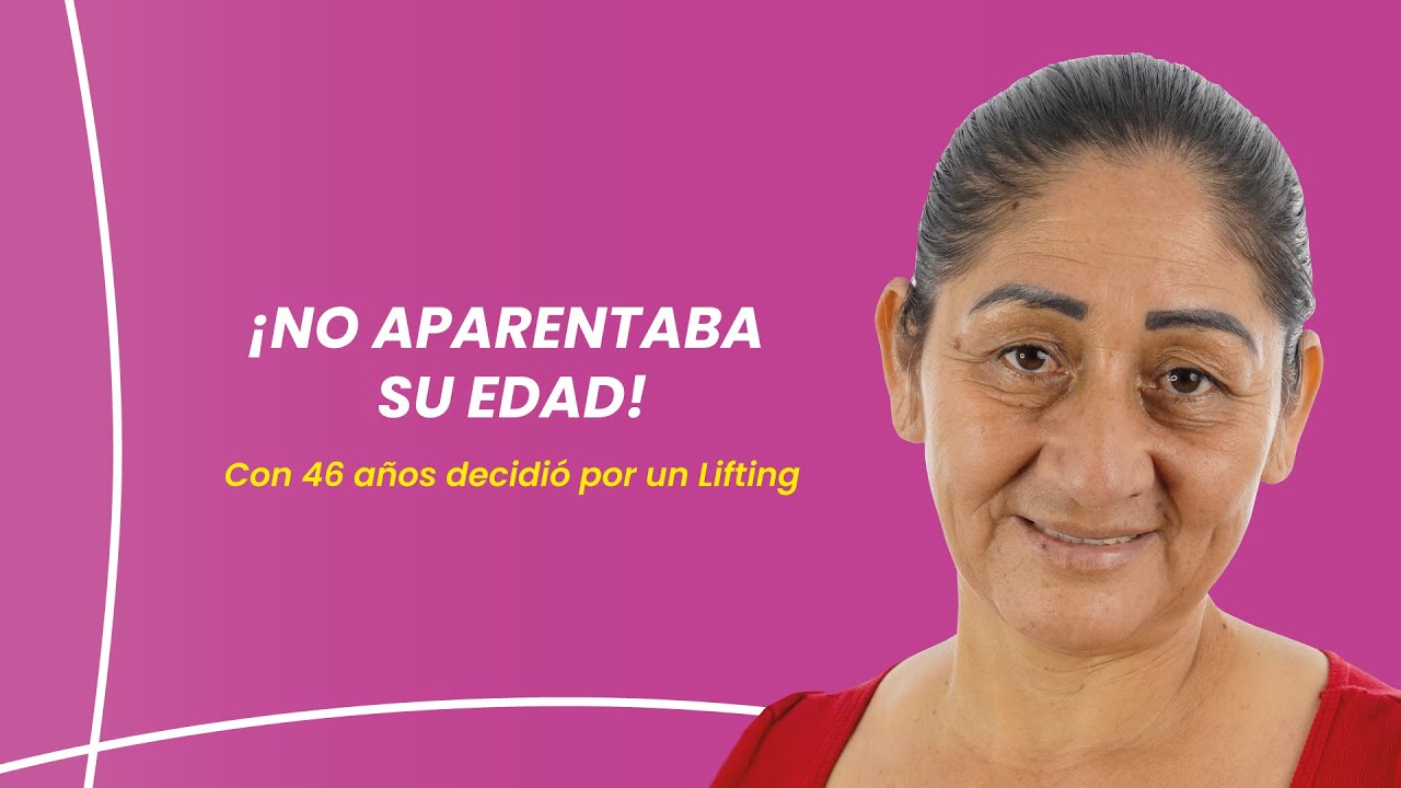 ¡NO APARENTABA SU EDAD! CON 46 AÑOS DECIDIÓ POR UN LIFTING