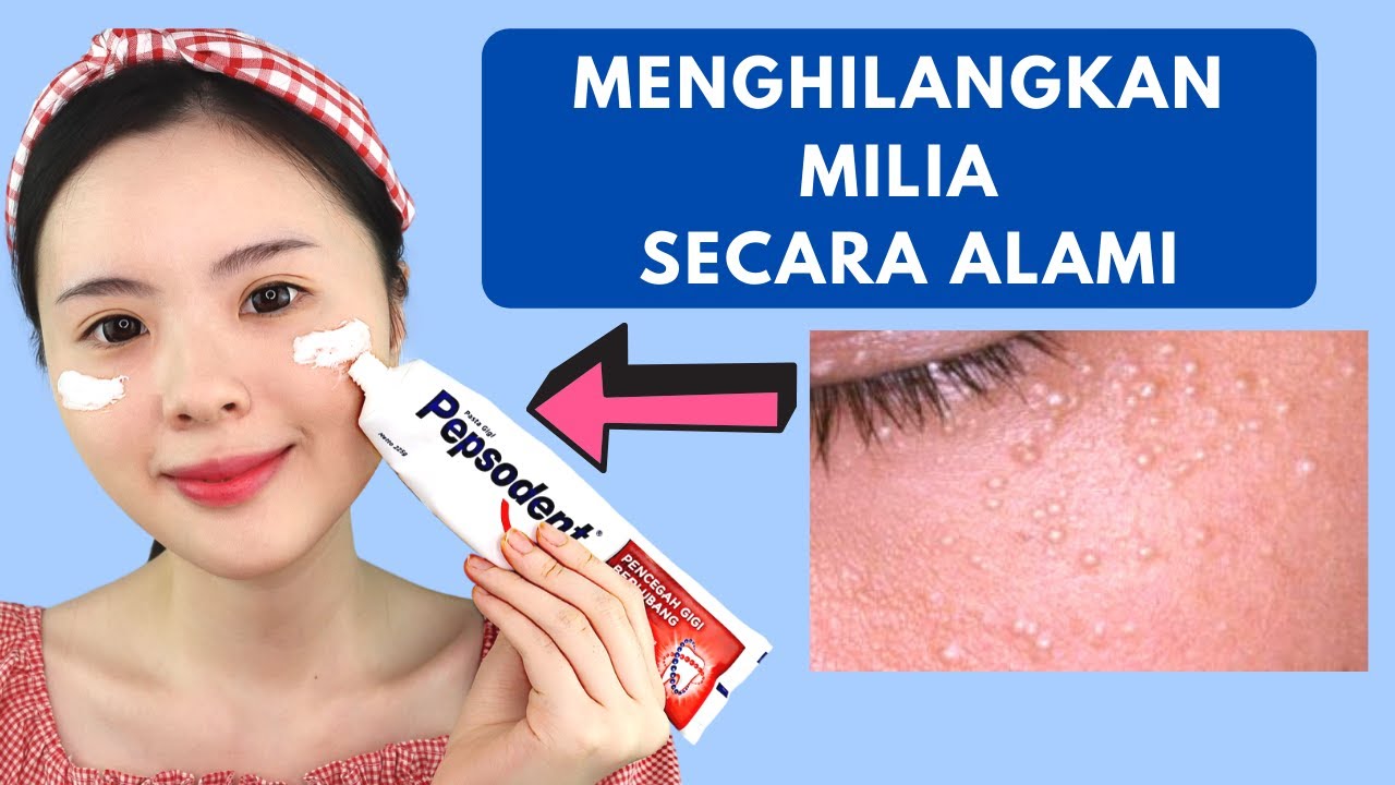 Cara Alami Menghilangkan Milia (AMPUH & CEPAT)