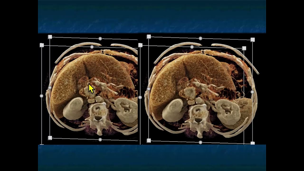 CT Evaluation of Small Bowel Obstruction: Pearls and Pitfalls in Clinical Practice - Part 1