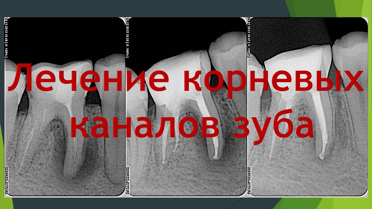 Секреты Стоматологии - Глава 3. Лечение Каналов