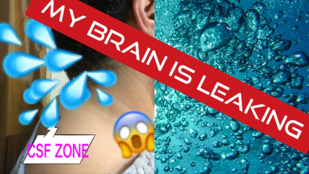 Chiari Sista~ CSF Leaks ~ Pre and Post Brain Surgery