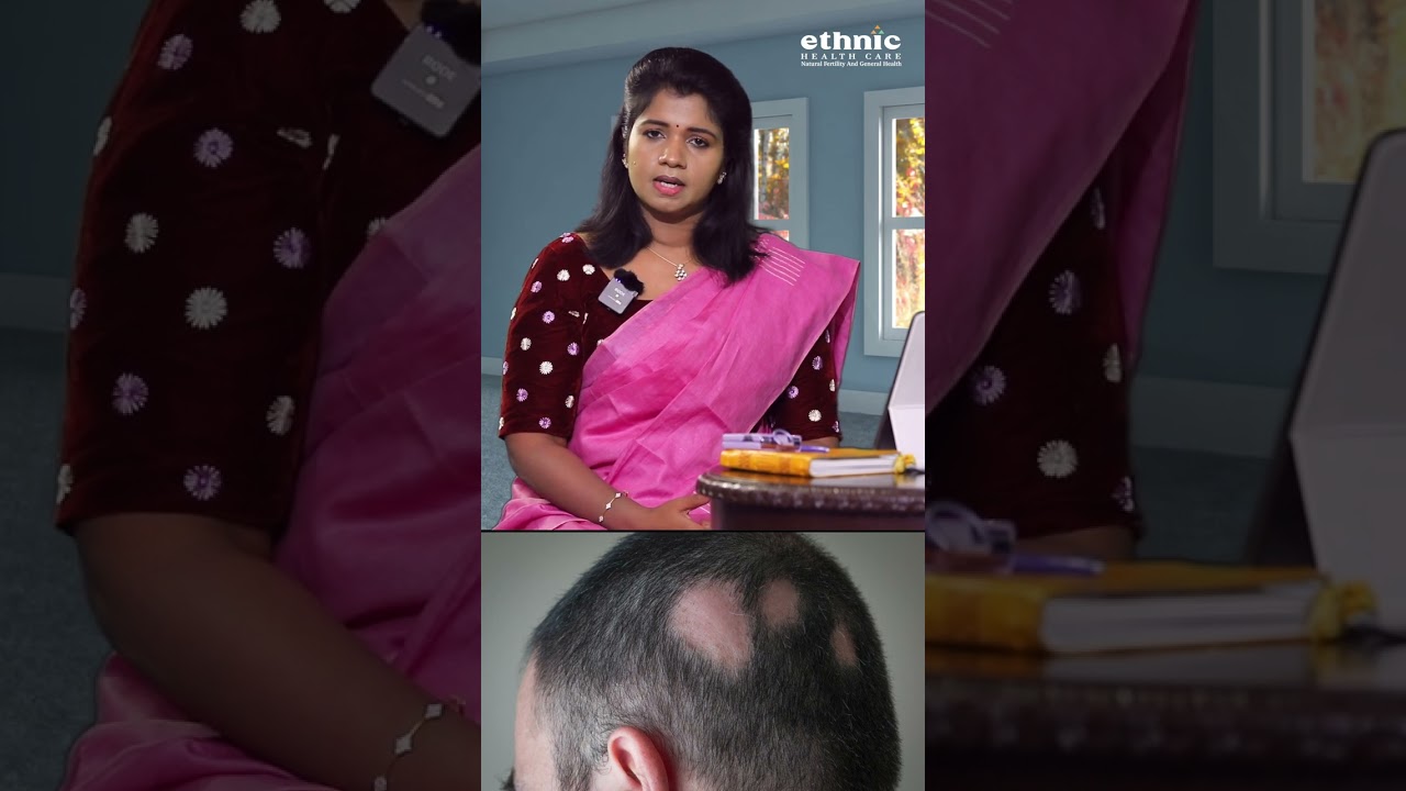 புழுவெட்டு முடி உதிர்வு ஏற்பட காரணம் என்ன !!  #health #alopecia #homeremedies #tips