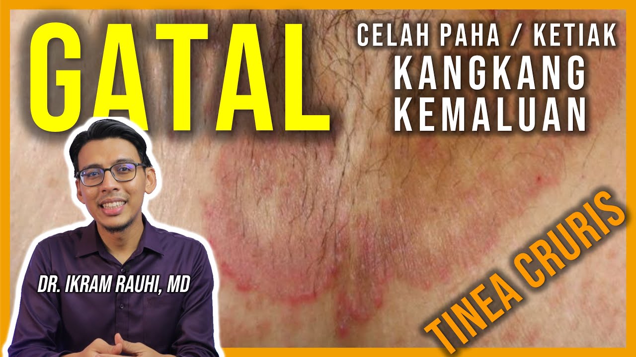 Punca dan Penyebab Gatal Celah Paha, Ketiak, Kangkang dan Kemaluan. Tinea Cruris. Rawatan.