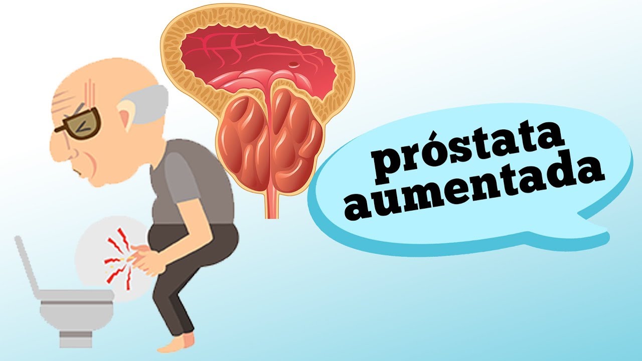 O QUE &Eacute; A PR&Oacute;STATA AUMENTADA? (HPB - HIPERPLASIA PROST&Aacute;TICA BENIGNA)