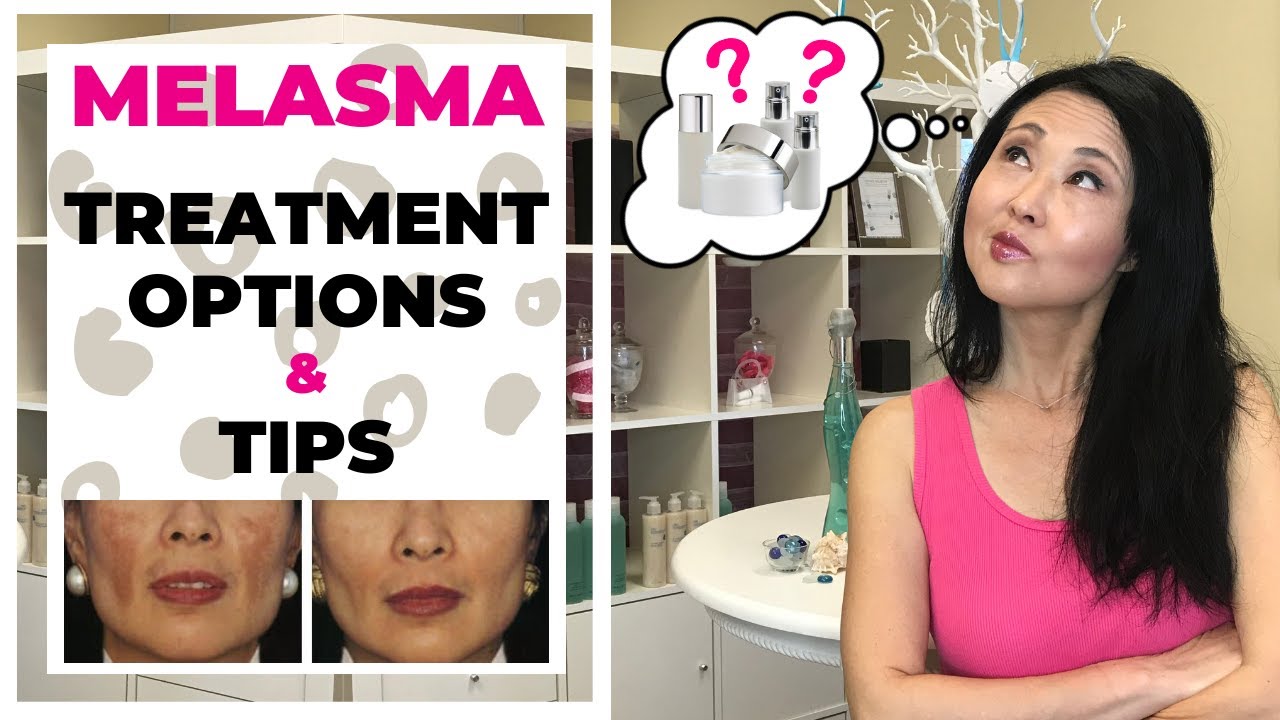 Melasma Treatment Options and Tips #melasmatreatment #goseechristy