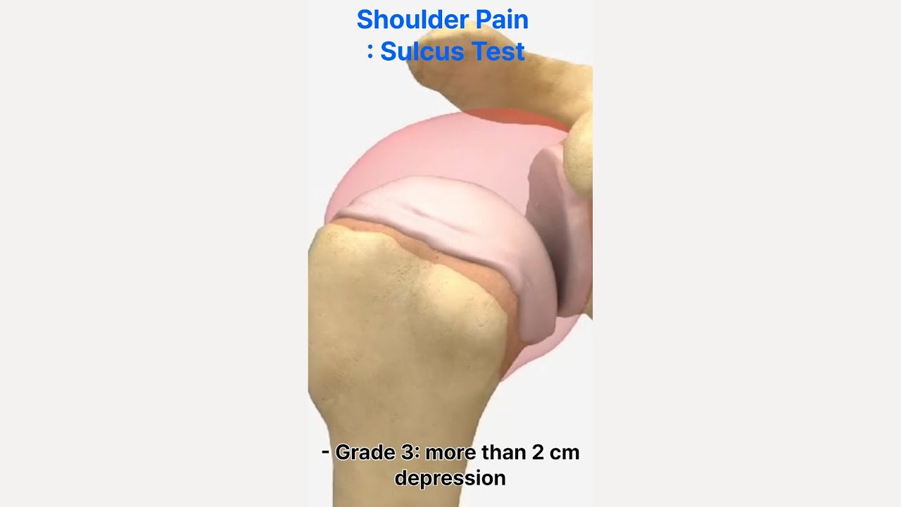 Shoulder Pain : Sulcus Test for Inferior and Multidirectional Instability