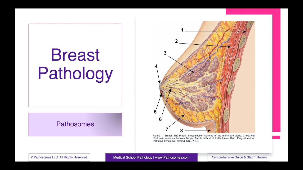 Breast Pathology | Comprehensive Guide & Step 1 Review | Pathology Step 1 USMLE