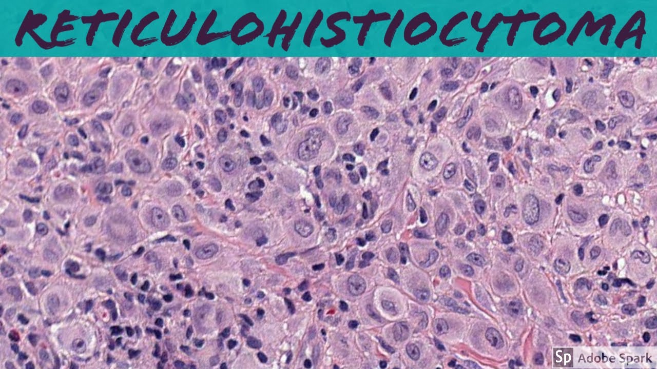 Reticulohistiocytoma: 5-Minute Pathology Pearls