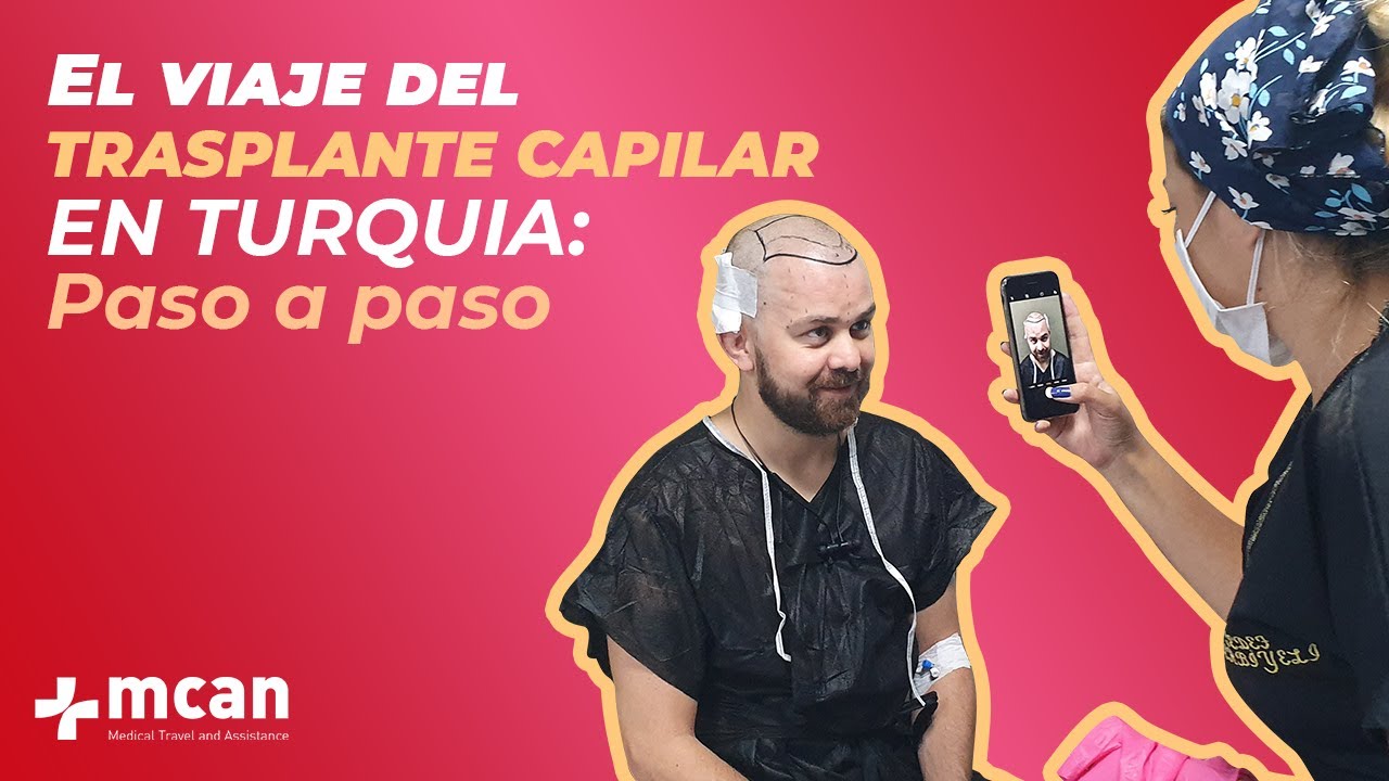 El viaje del Trasplante Capilar en Turquía: Paso a paso