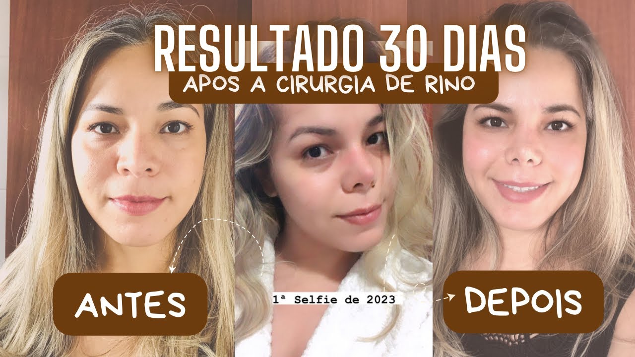 RESULTADO 30 DIAS APÓS RINO - Diário da Rinomodelação Definitiva