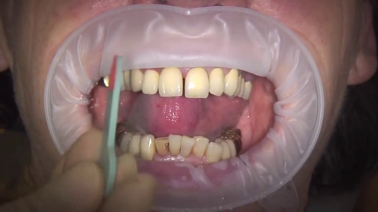 Bausch Fleximeter Strips