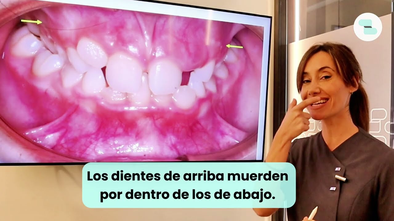 Ortodoncia para un PALADAR ESTRECHO