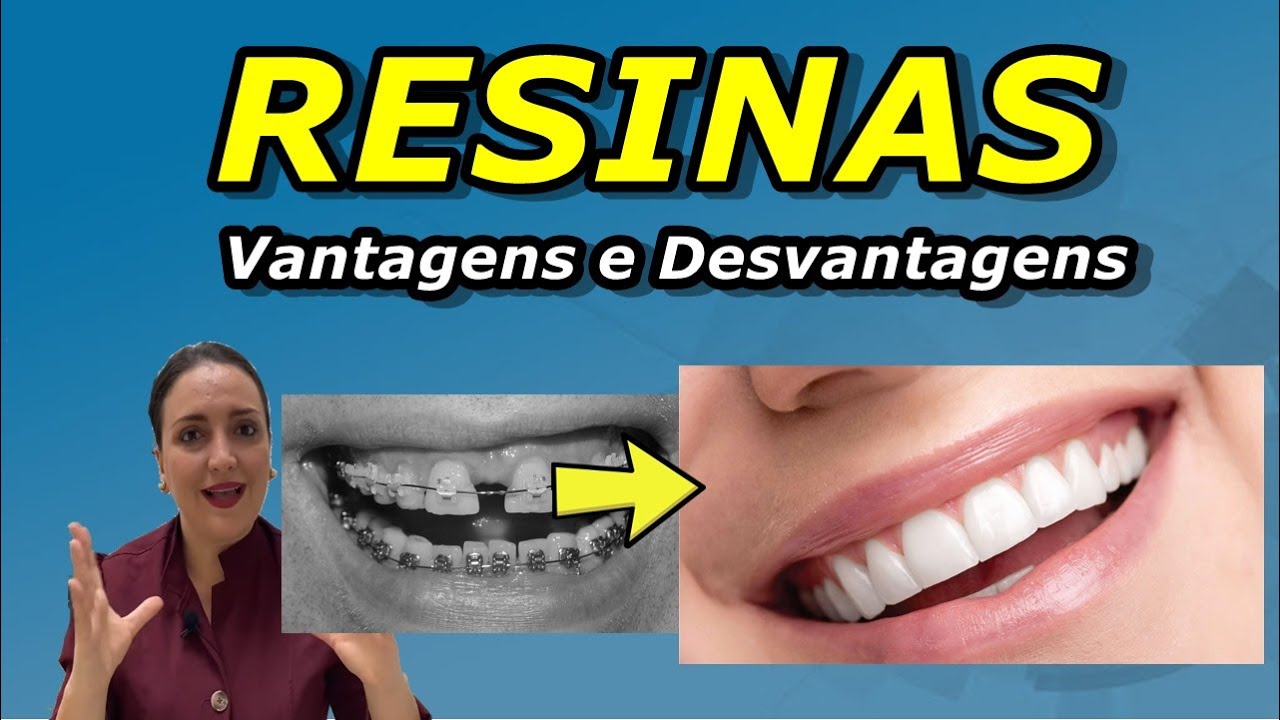 FACETAS DE RESINA | VALE A PENA FAZER APÓS TIRAR O APARELHO?