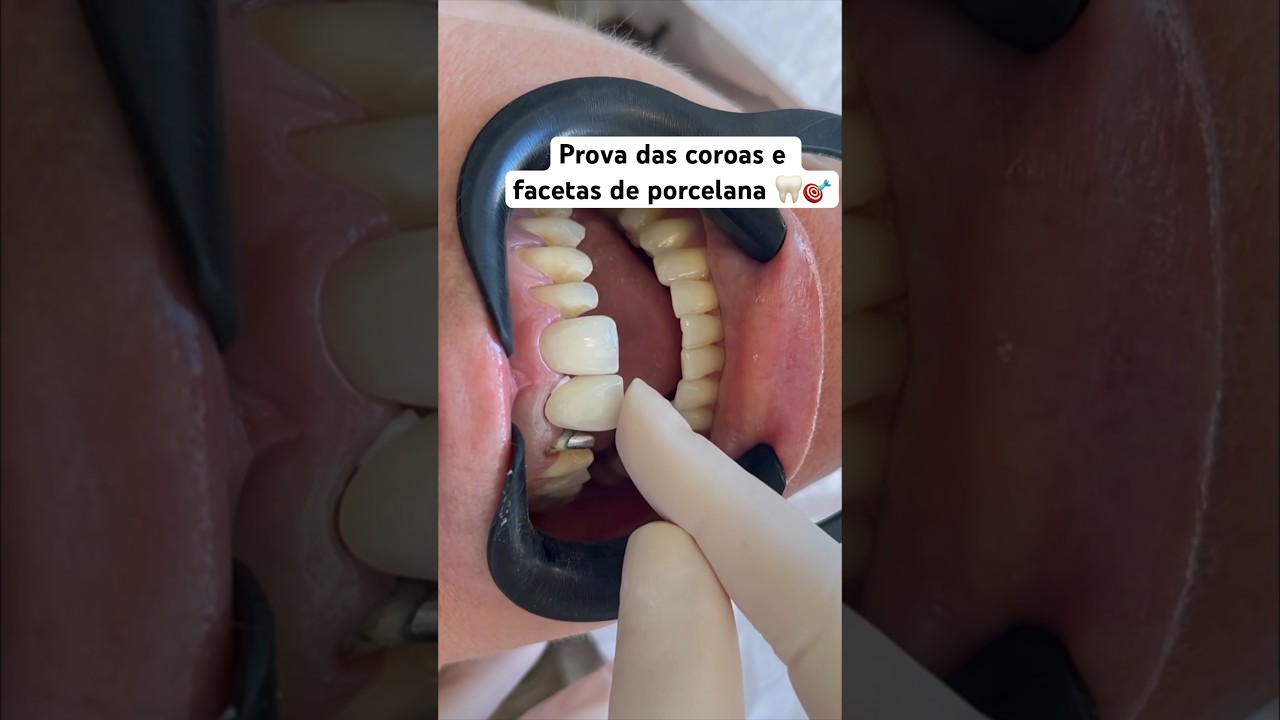 Prova com try in 🎯 #facetadental #dentista #dentistasbrasil #odonto #odontologia #facetas