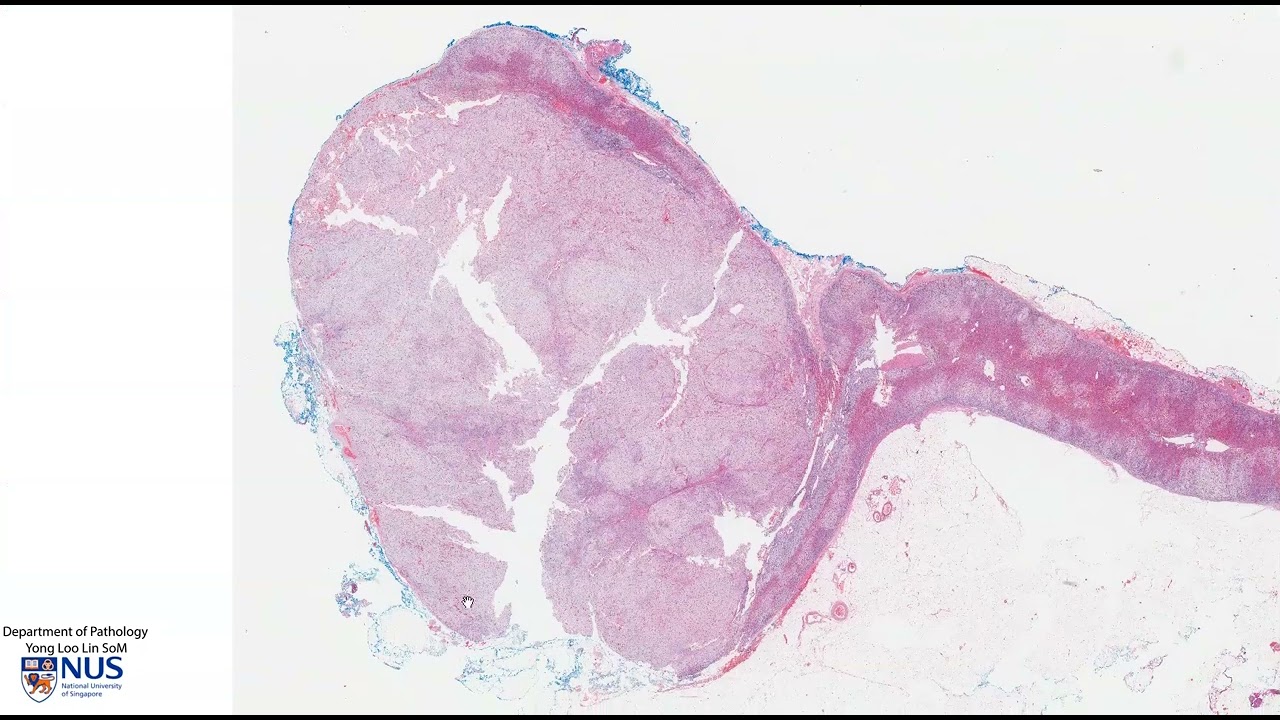 Adrenal gland: Adrenocortical adenoma - Talking slide