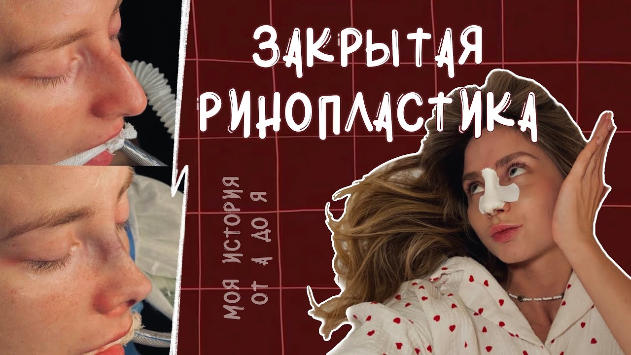 Закрытая Риносептопластика - моя история