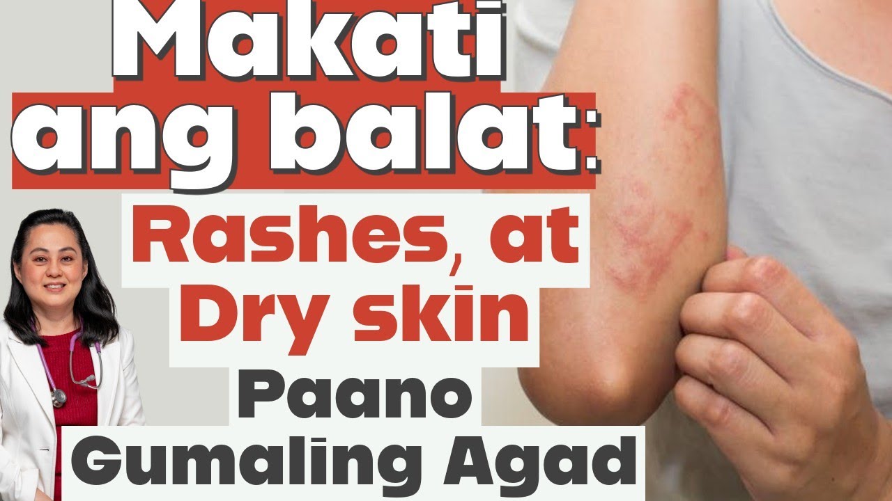 Makati ang Balat, Rashes at Dry Skin: Paano Gumaling Agad? - Payo ni Doc Liza Ramoso-Ong
