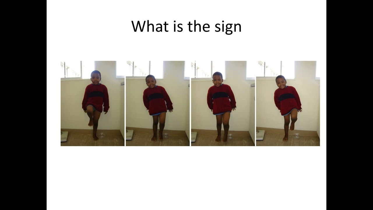 Stewart Dix-Peek- Lower limb deficiencies