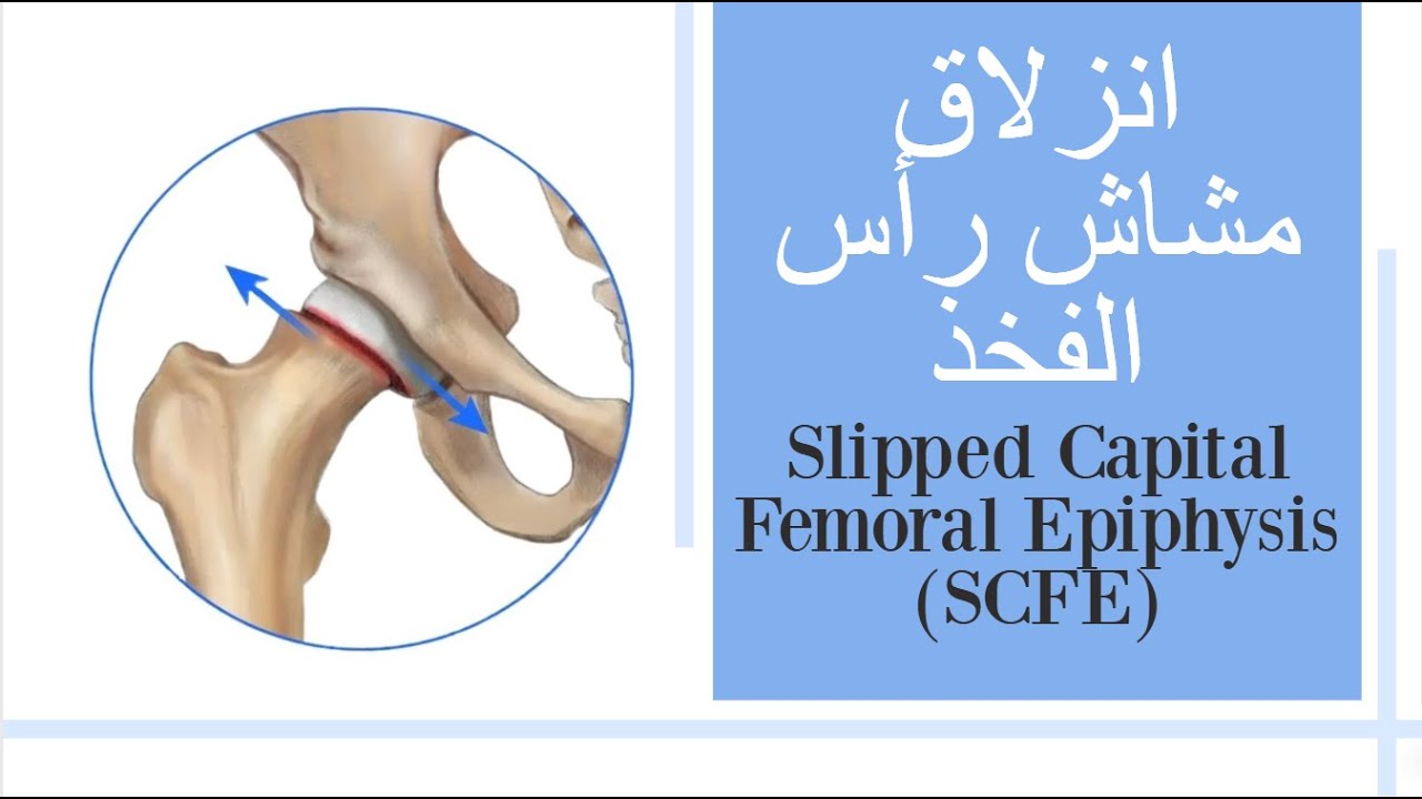 انزلاق مشاش رأس الفخذ - Slipped Capital Femoral Epiphysis (SCFE) (subtitled)