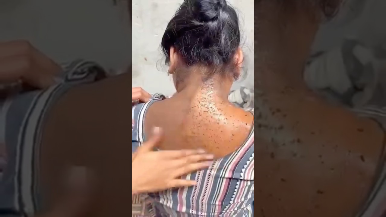 Remove Neck Dirt & Tanning In Just2minutes#darknecksolution#neckcleaningtips #bleach