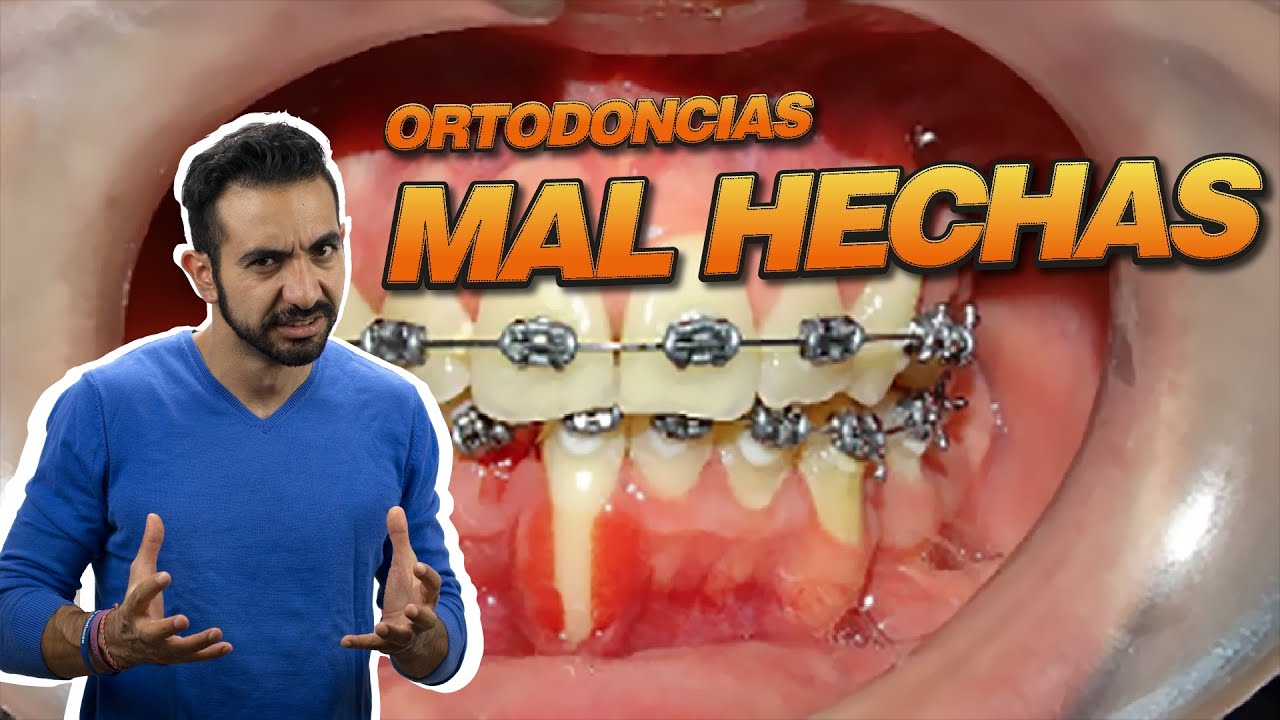 Ortodoncias Mal Hechas. Cómo Corrijo Malos Tratamientos de Ortodoncia. I Tu dentista de confianza