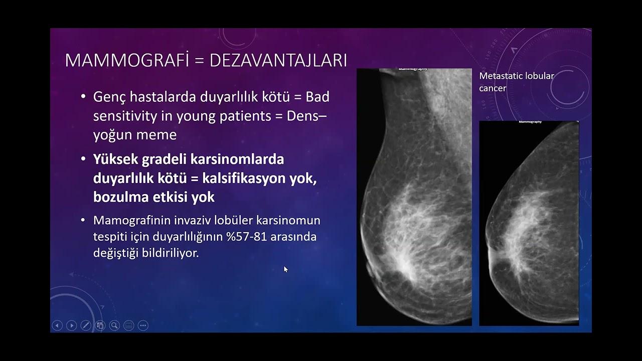Anlatımlı Radyoloji dersi 7 - Kanser taramaları, Meme görüntüleme