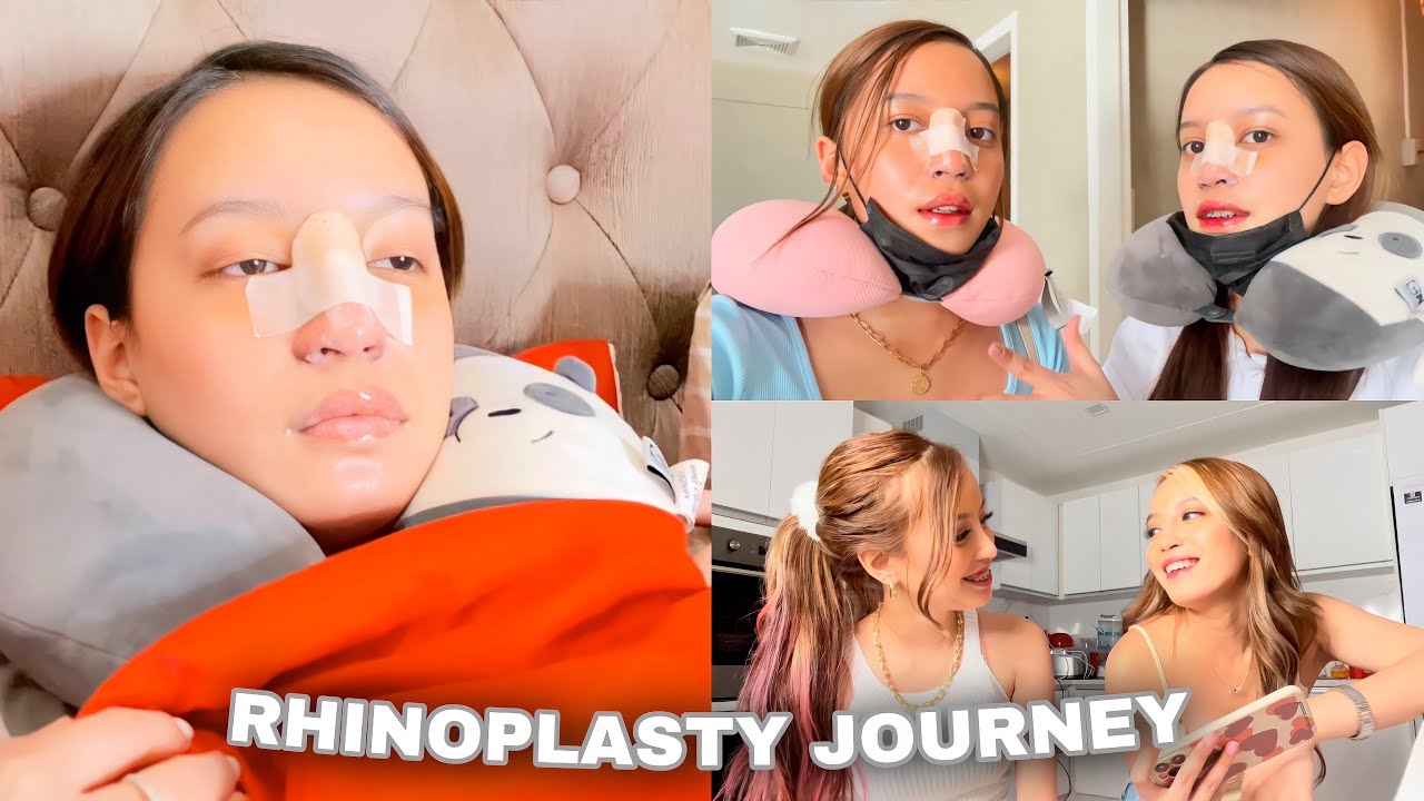 RHINOPLASTY JOURNEY (ang hirap)