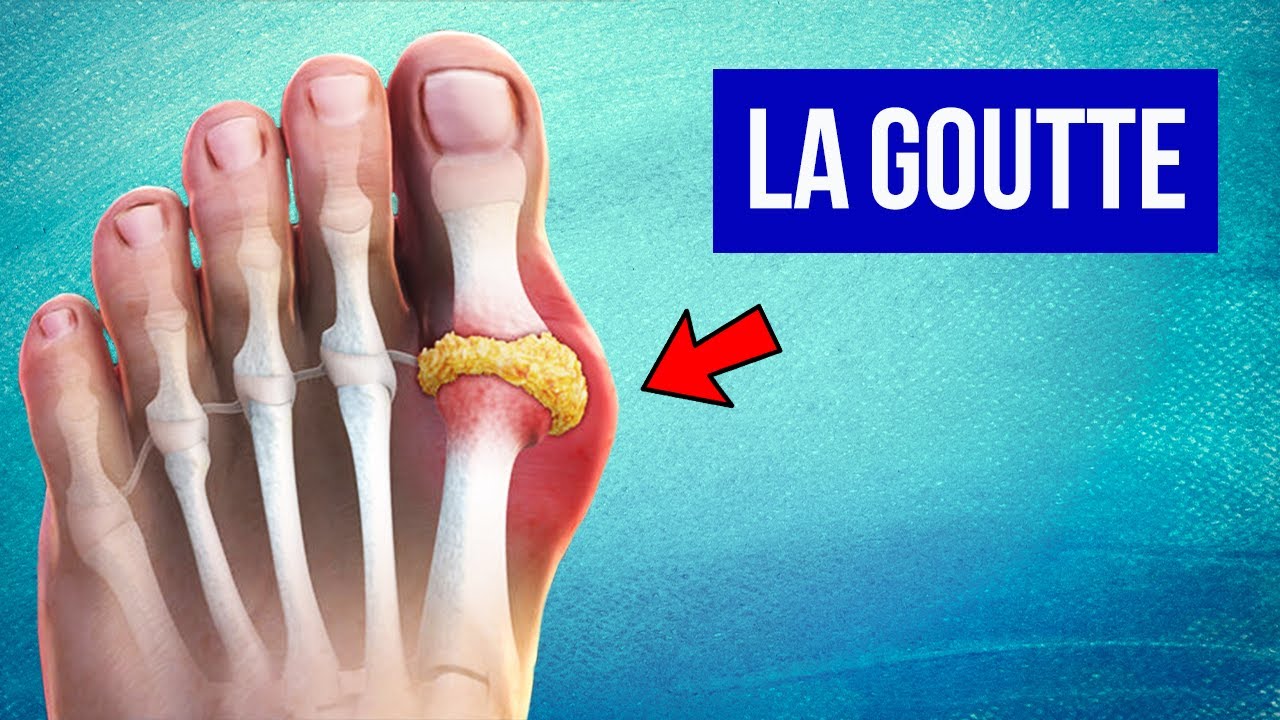 Crise de goutte  : M&eacute;canisme et Traitements