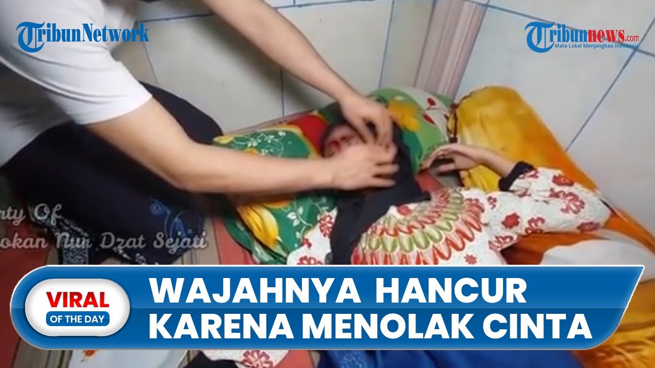 Viral, Gadis yang Wajahnya Jadi Hancur karena Diduga Menolak Cinta, Ayah: Dia Anak Satu-satunya
