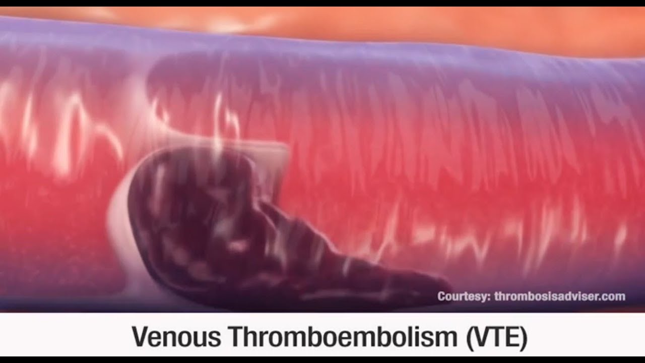 Signs and Symptoms of VTE