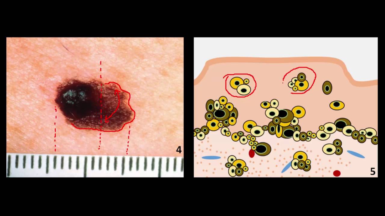 Introduction to Skin Cancer #4: The ABCDEs of Melanoma