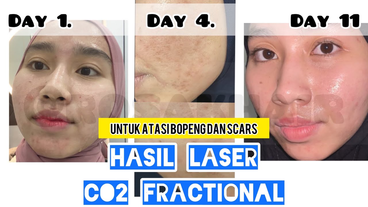 BEFORE AFTER LASER CO2 FRACTIONAL | UPDATE PROGRESS MENGURANGI BOPENG
