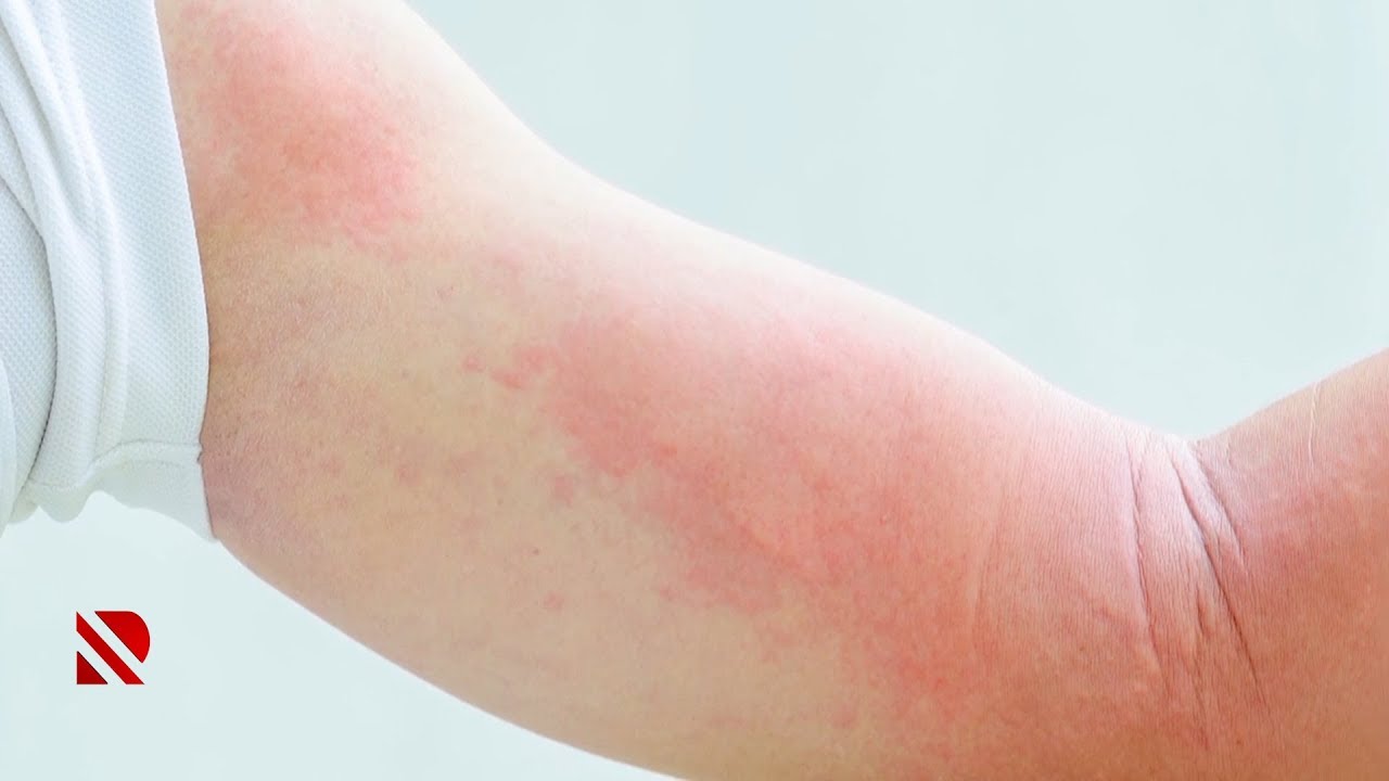 Allergiya genetik ötürülür