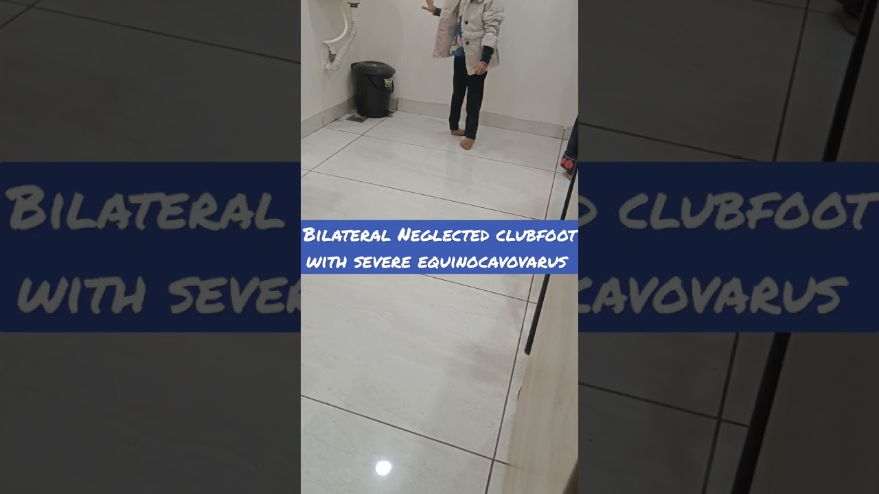 bilateral congenital talipes equinocavovarus foot or clubfoot or CTEV.Walking on dorsolateral border