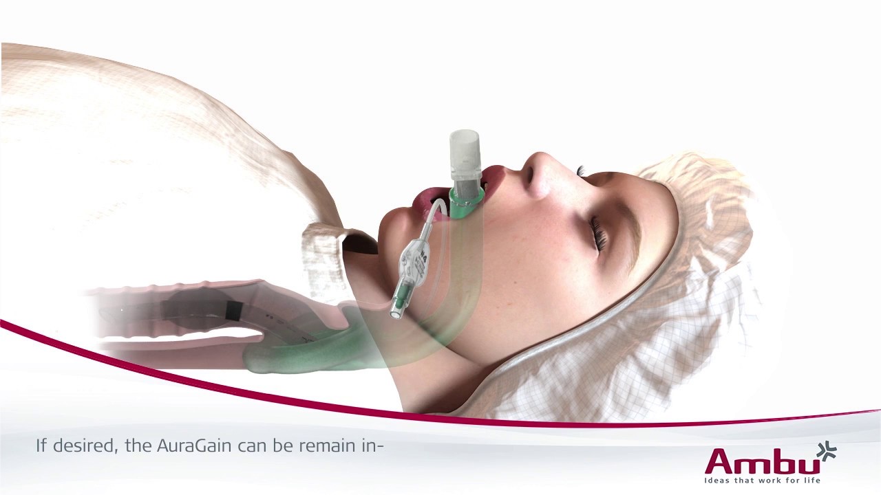Intubation with Ambu aScope through AuraGain