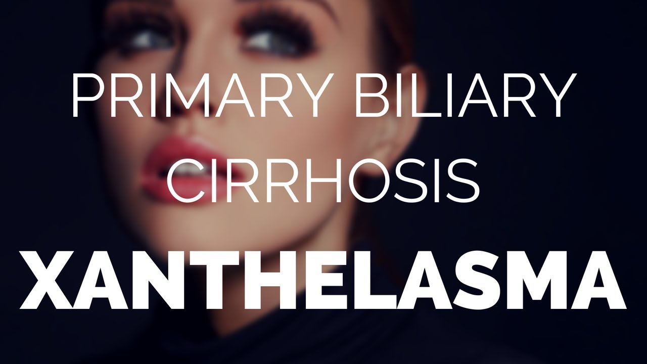 Primary biliary cirrhosis xanthelasma explained