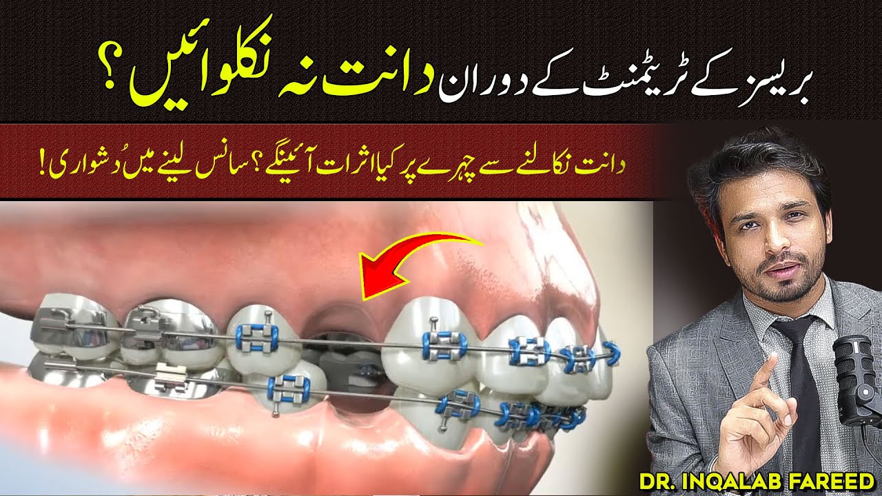 Side Effects of Teeth Extraction for BRACES Treatment!