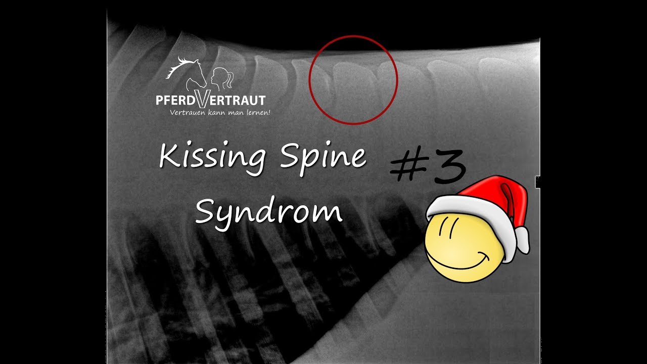 [X-MAS 2017] #3 - Diagnose: Kissing Spine Syndrom