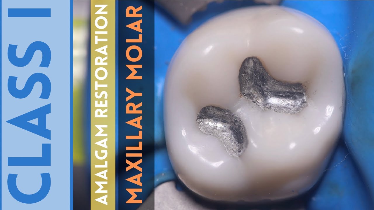 Class I Amalgam Restoration 🟡 Amalgam Class I Cavity 🟢 Maxillary Molar 🔵 Step By Step