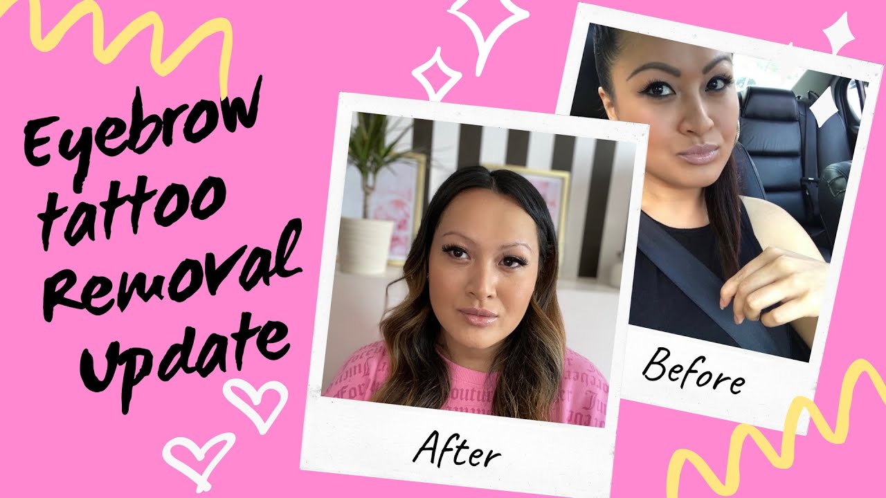 Eyebrow Tattoo Removal Update!! + Q&A