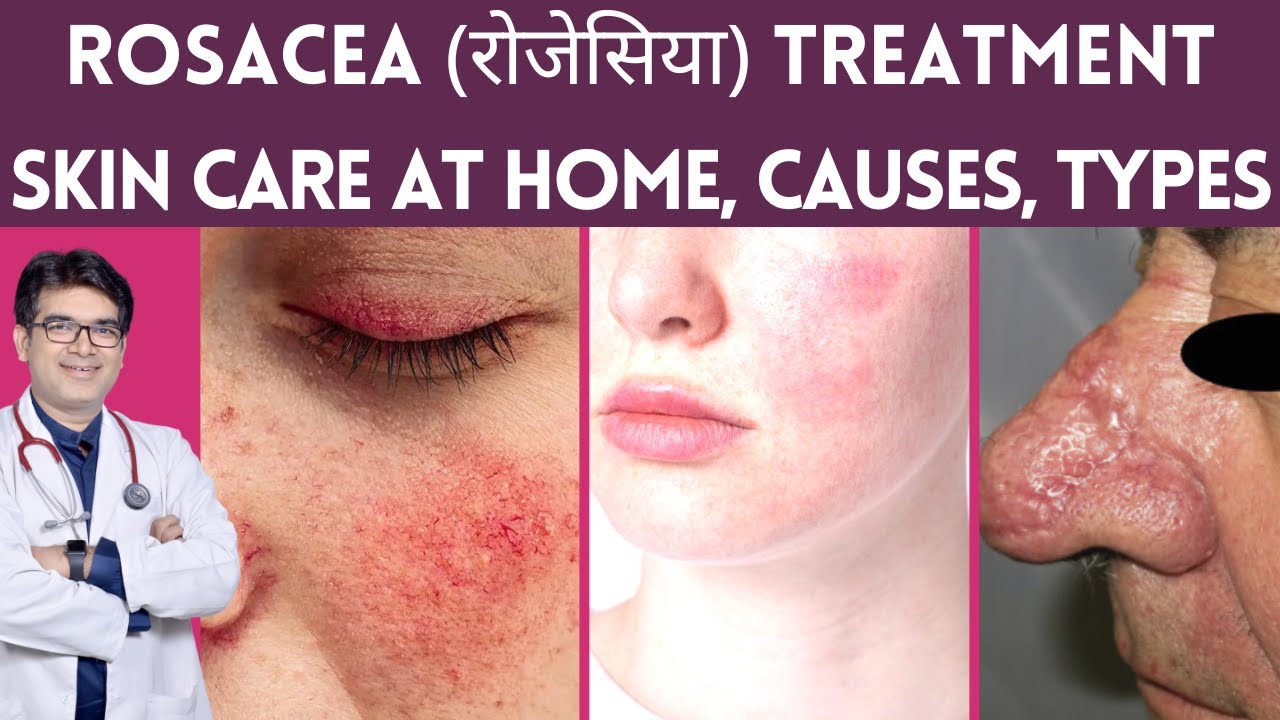 Rosacea Treatment, Skin Care, Laser Treatment | Rosacea का इलाज | Rosacea Causes, Types | Hindi