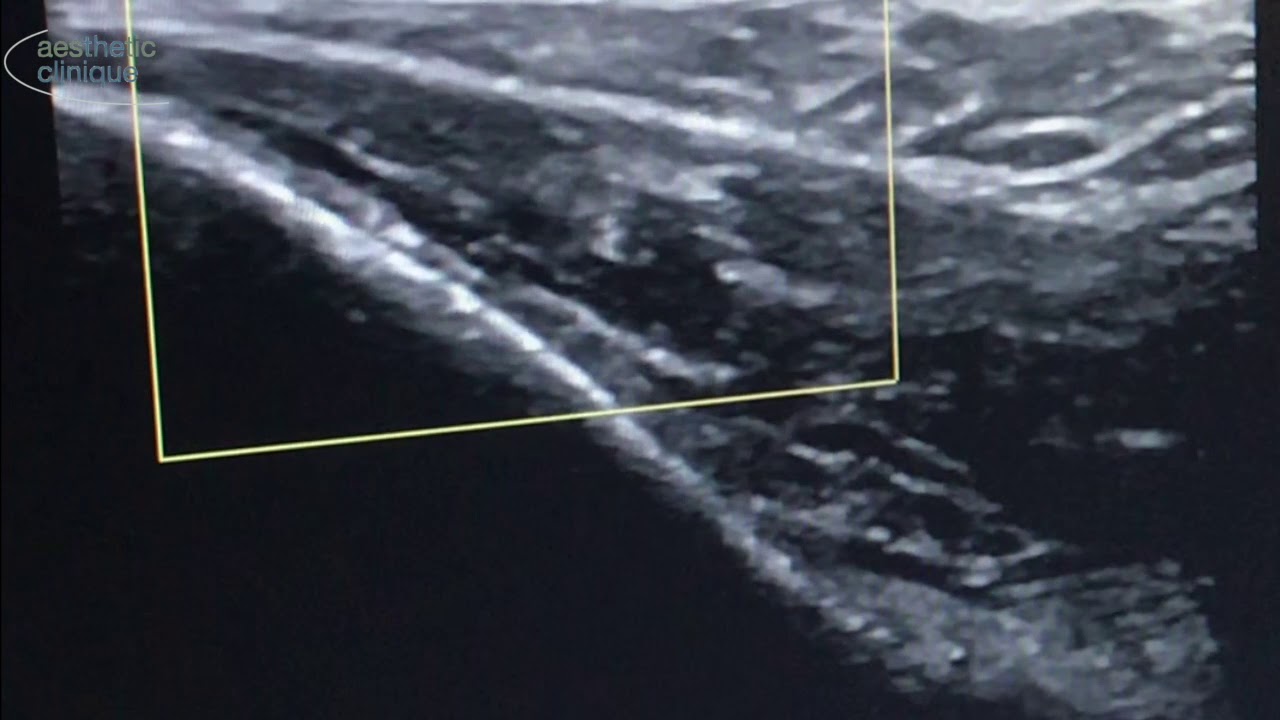 Are Deep Temporal Filler Injections Safe? Dr. Weiner Evaluates Temple With Ultrasound
