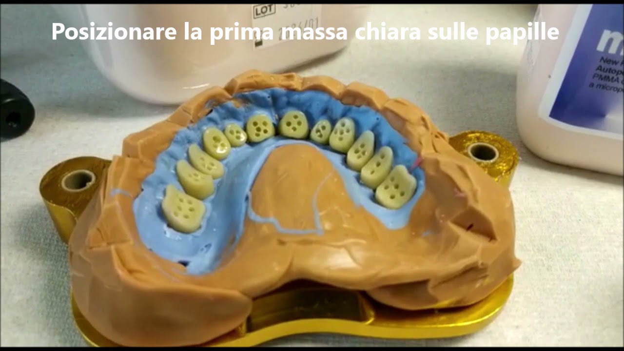 Protesi Mobile, Tecnica pressata,caratterizzazione flange in 5 minuti