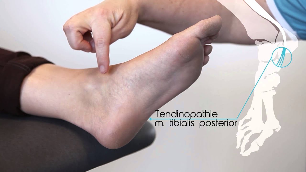 Tendinopathie m. tibialis posterior